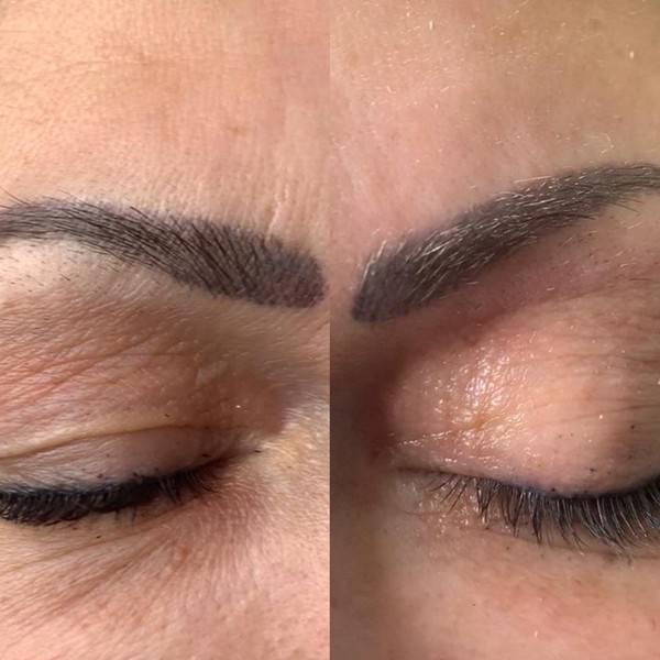 Avant/Après TeslaMed D — Contour des yeux