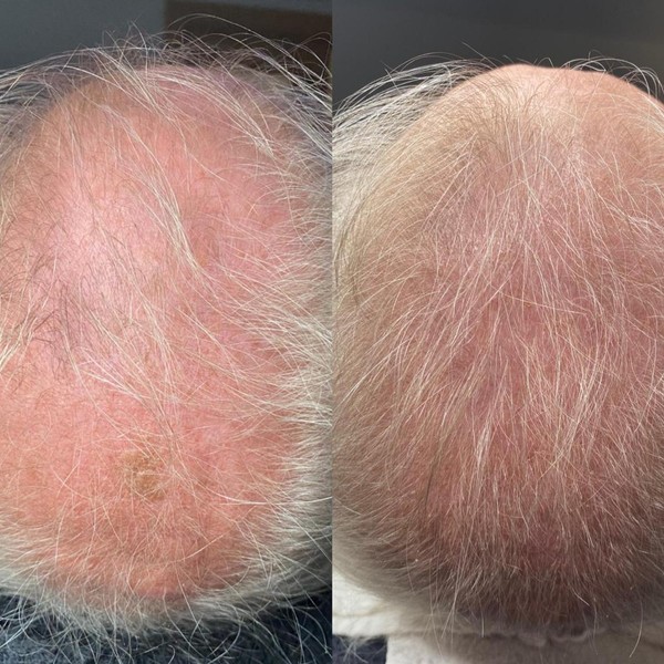 Avant/Après TeslaMed E — Scalp (cuir chevelu)