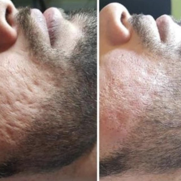 Avant/Après TeslaMed F — Resurfaçage visage