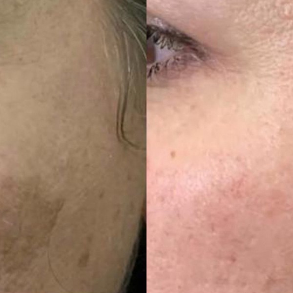 Avant/Après TeslaMed G — Soin visage
