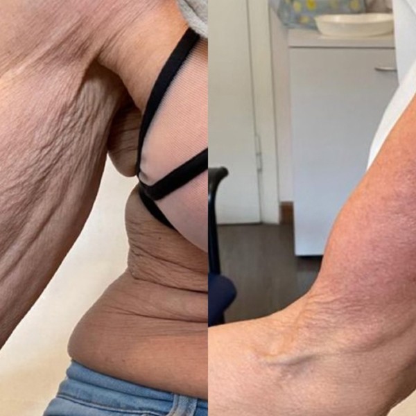 Avant/Après TeslaMed H — Élasticité bras
