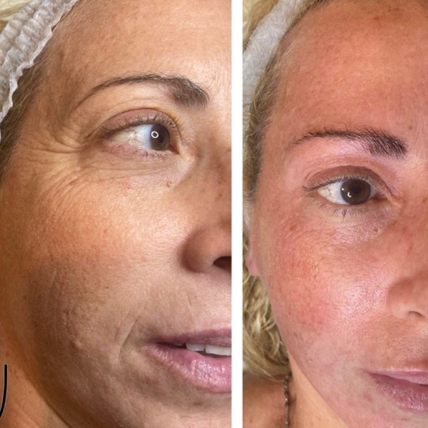 Avant/Après TeslaMed L — Soin visage