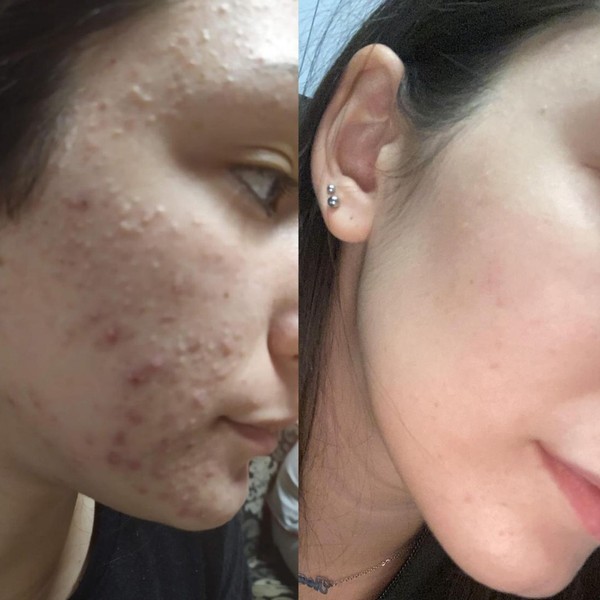 Avant/Après TeslaMed M — Acné inflammatoire