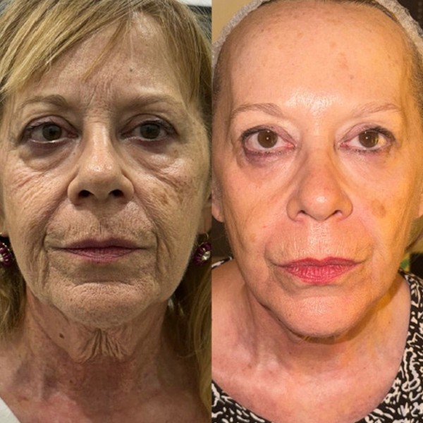 Avant/Après TeslaMed N — Soin visage