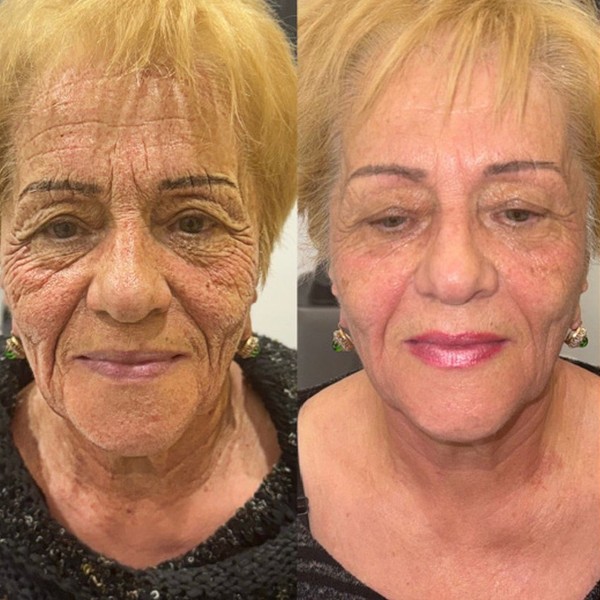 Avant/Après TeslaMed O — Soin visage