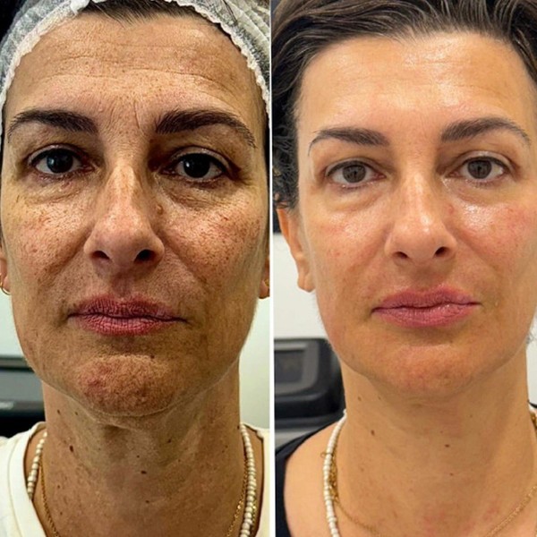 Avant/Après TeslaMed P — Soin visage